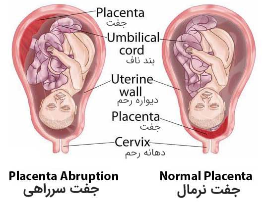 جفت سرراهی و جفت نرمال