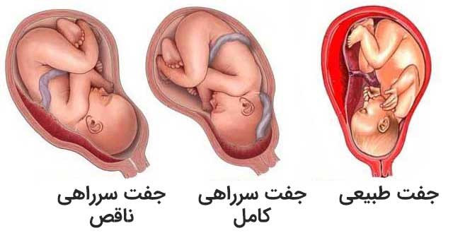 مقایسه جفت طبیعی و سرراهی کامل و ناقص