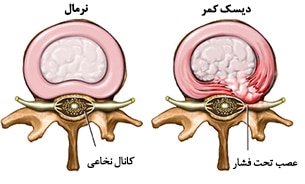 علائم و درمان دیسک کمر