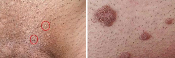 زگیل تناسلی-واکسن گارداسیل