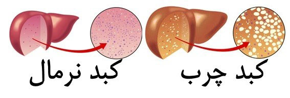 کبد چرب و کبد نرمال