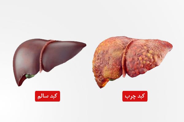 علائم و نشانه های کبد چرب